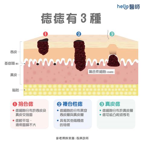 生痣原因